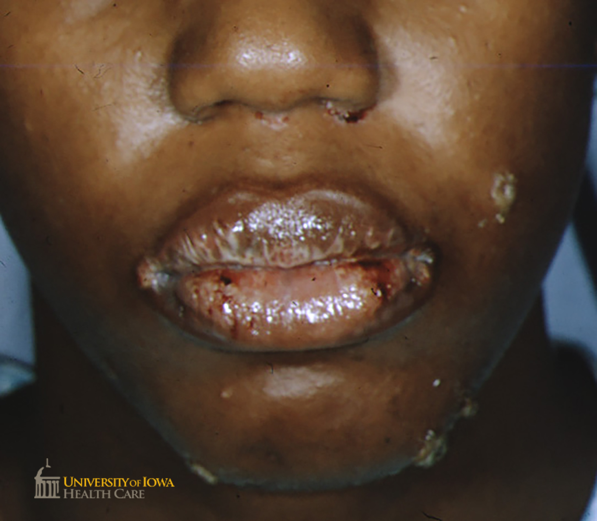 Superficial erosions, some with hemorrhagic crusting and scale, on the lips and face. (click images for higher resolution).